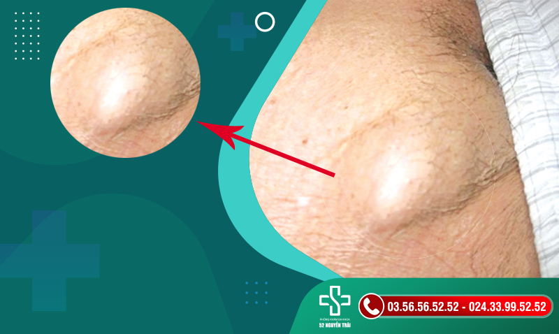 Bị nổi hạch, nổi cục ở vùng kín là bệnh gì? Có nguy hiểm không?