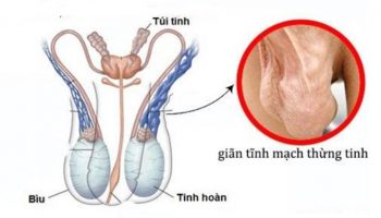 dấu hiệu dãn tĩnh mạch thừng tinh