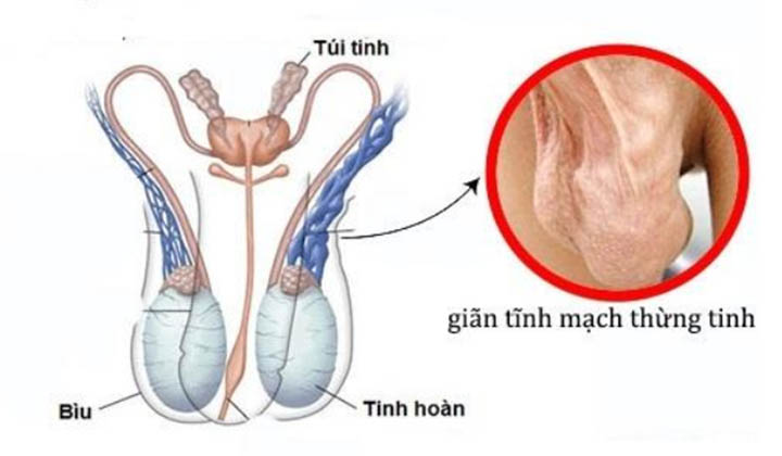 Giãn tĩnh mạch thừng tinh: Dấu hiệu nhận biết bệnh và cách điều trị hiệu quả