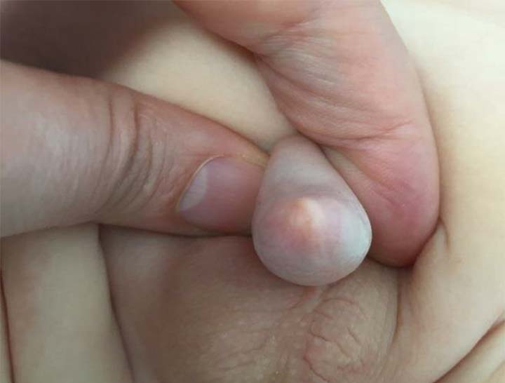 Hình ảnh hẹp bao quy đầu ở trẻ em: Bác sĩ chuyên khoa mạch cách sử lý hiệu quả
