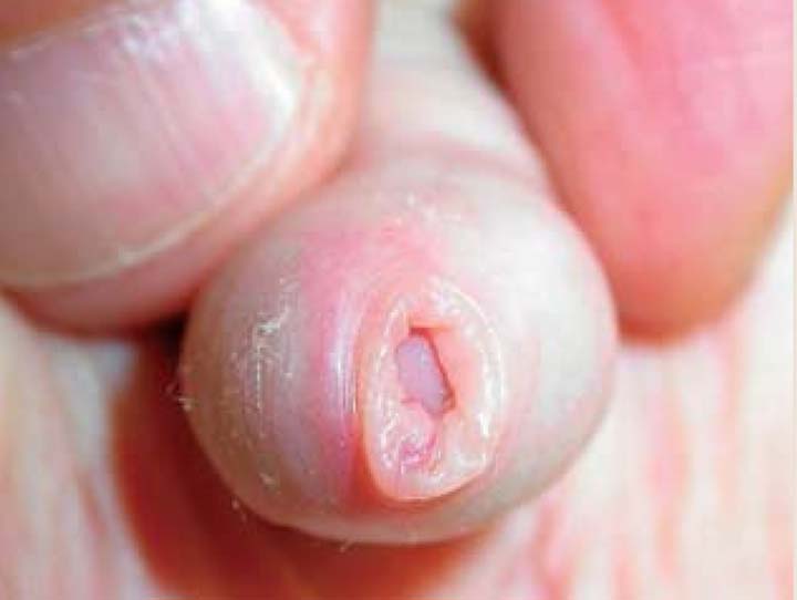 hẹp bao quy đầu ở trẻ