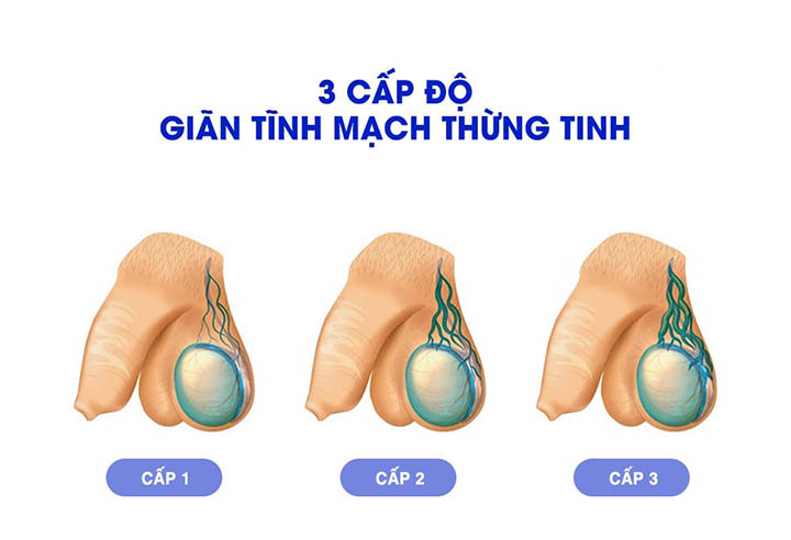 các mức độ giãn tĩnh mạch thừng tinh