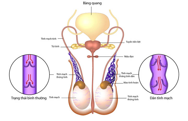 Nguyên nhân dãn tĩnh mạch thừng tinh