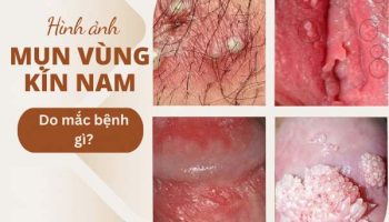 nguyên nhân vùng kín nổi mụn