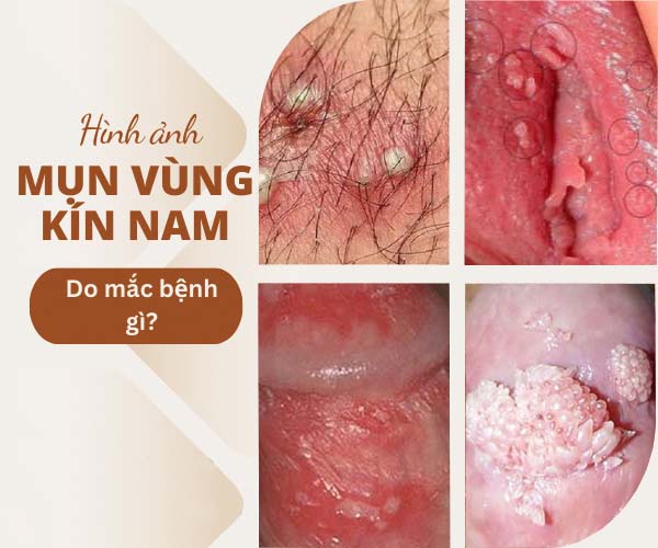 VÙNG KÍN NỔI MỤN LÀ DẤU HIỆU CỦA BỆNH GÌ, ĐỊA CHỈ KHÁM UY TÍN TẠI HÀ NỘI