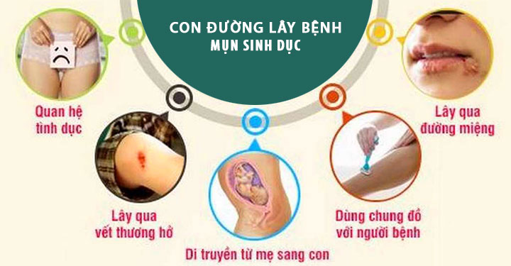 con đường lây mụn rộp