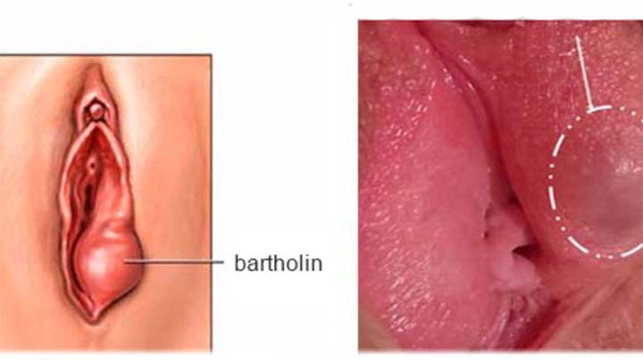 Bartholin-viem