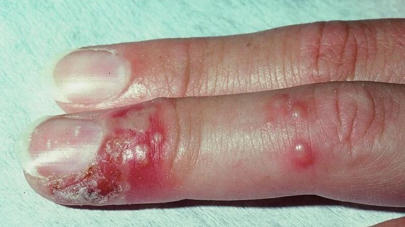 benh-herpes-sinh-duc-nguyen-nhan-dau-hieu-va-bien-8-800x450