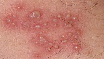 mụn rộp sinh dục giai đoạn đầu