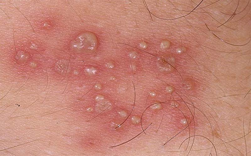 Bệnh Mụn rộp (Herpes) sinh dục: Nguyên nhân, triệu chứng và cách điều trị hiệu quả
