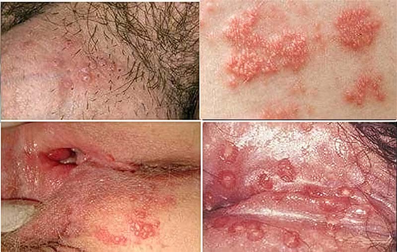 mụn rộp sinh dục