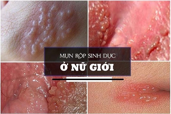mụn rộp sinh dục nữ