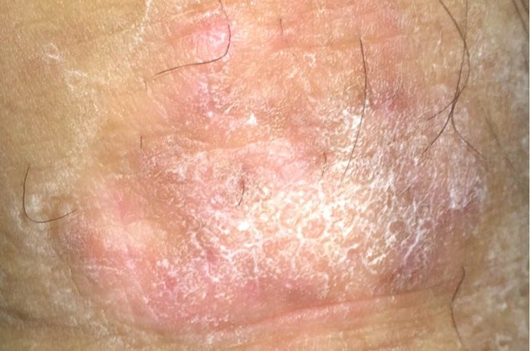 Bệnh chàm bìu 2