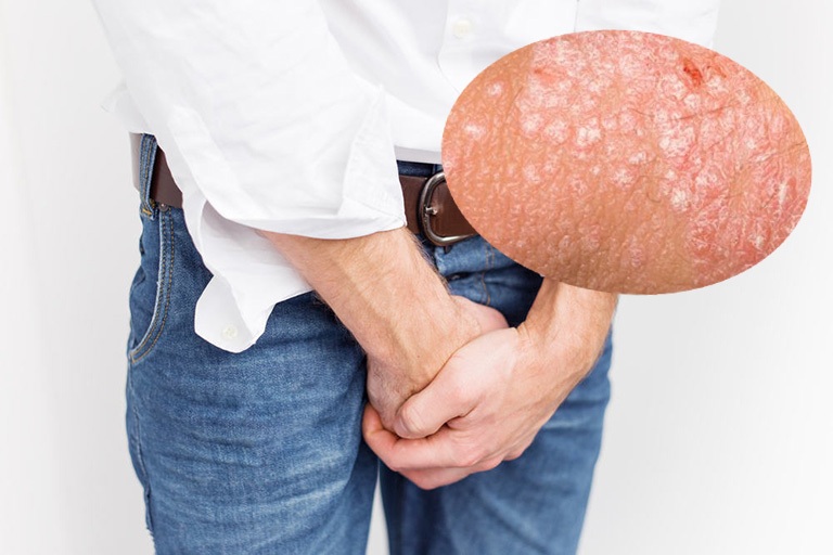 BỆNH CHÀM BÌU: NGUYÊN NHÂN, TRIỆU CHỨNG NHẬN BIẾT VÀ CÁCH ĐIỀU TRỊ HIỆU QUẢ