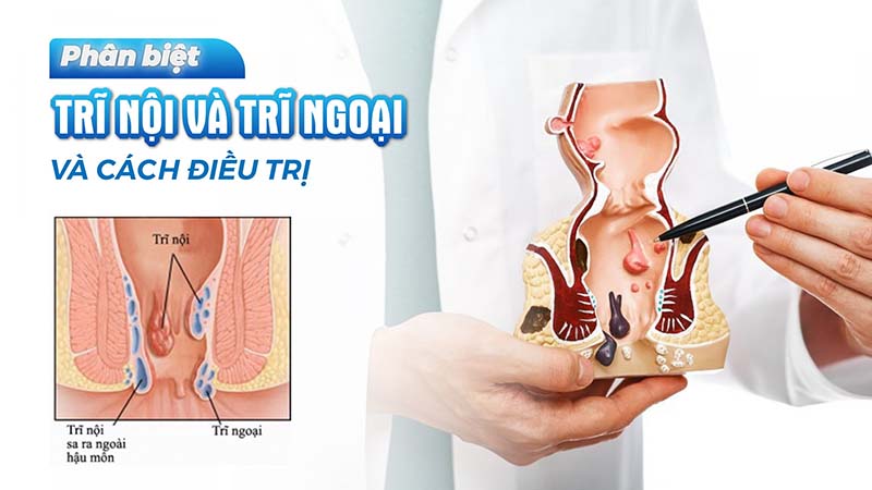 Đâu Là Địa Chỉ Phòng Khám Trĩ Tốt Tại Hà Nội? Gợi Ý Lựa Chọn Đúng Ngay Từ Đầu