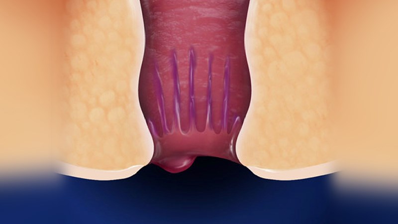 dấu hiệu bệnh trĩ