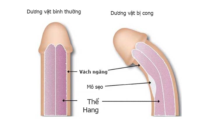 dương vật cong bất thường