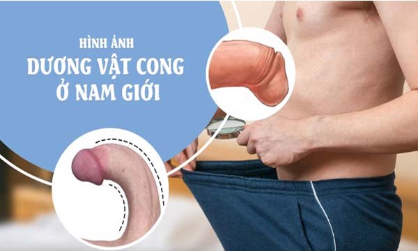 Dương Vật Bị Cong Có Sao Không? Tìm Hiểu Nguyên Nhân Và Cách Khắc Phục Hiệu Quả