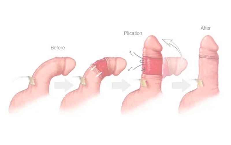 điều trị cong dương vật