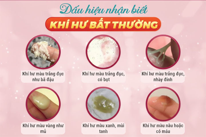 khí hư bất thường