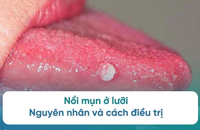Nổi mụn thịt ở lưỡi có phải bị sùi mào gà không? Dấu hiệu nhận biết sùi mào gà ở lưỡi