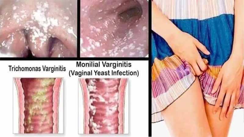 biểu hiên nâm âm đạo