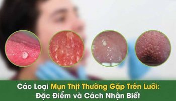 mụn thịt ở lưỡi