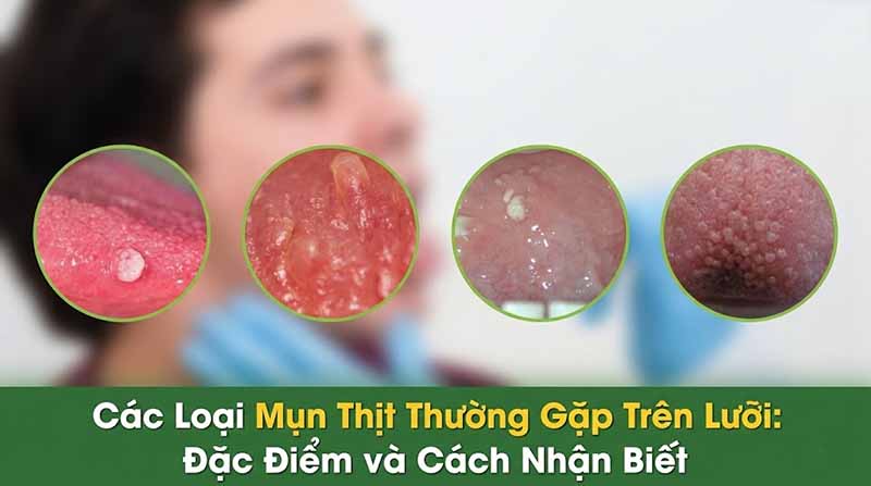 Nổi mụn thịt ở cuống lưỡi là bị sao? Có phải bệnh sùi mào gà không?