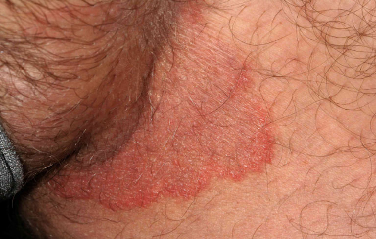 Bị viêm da vùng kín & Cách xử lý hiệu quả