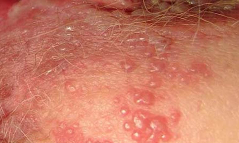 bệnh herpes gây mụn ngứa vùng kín