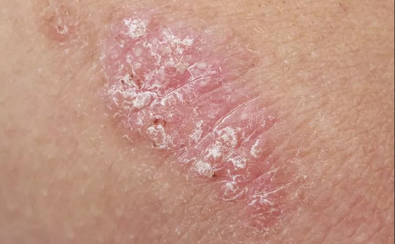 Hiện tượng ngứa vùng kín có vảy trắng