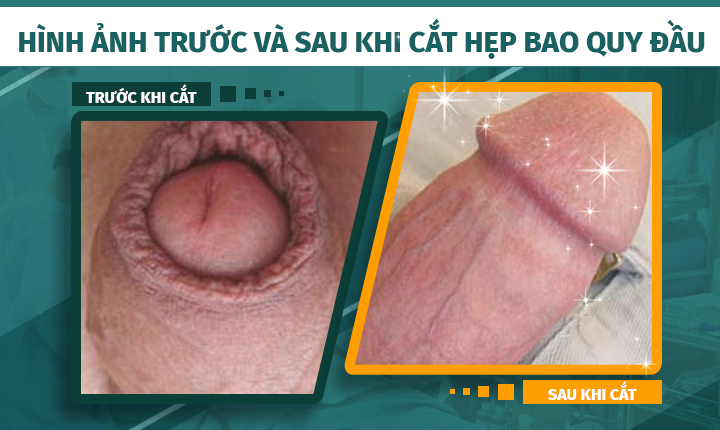 cắt bao quy đầu