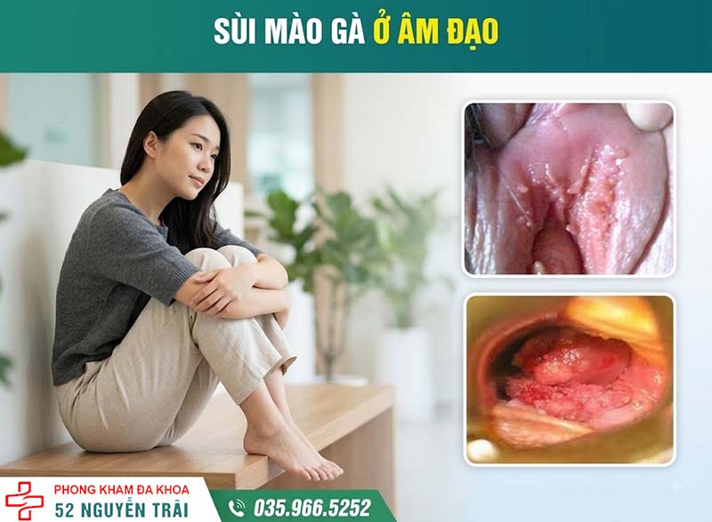 sùi mào gà