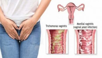 viem-am-dao-do-nam-trichomonas