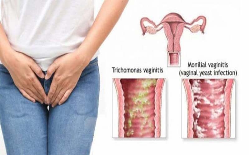 Ngứa ở bộ phận sinh dục nam và nữ cảnh báo những bệnh lý nào?