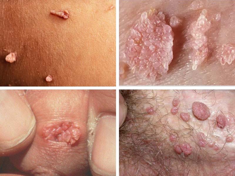 Đầu dương vật nổi mẩn đỏ ngứa là bệnh gì? Cách chữa trị
